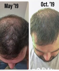 Growth Treatment Unscented 5% (Foam) 2 Ounce (Pack of 1) 21 719IWwseCgL