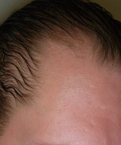 DHT BLOCKER - Hair Growth Supplement for Genetic Thinning for Men and Women | Approved* by American Hair Loss Association | Guaranteed, Backed by 20 Years of Experience in Hair Loss Treatment Clinics 50 71A82lfcpL