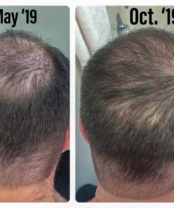 Growth Treatment Unscented 5% (Foam) 2 Ounce (Pack of 1) 22 71AdcXNcgML