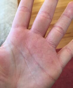 PUR360 Tamanu Oil - Best Treatment for Psoriasis, Eczema, Acne Scar, Rosacea - Relief for Dry, Scaly Skin, Scalp and More - Cold Pressed – Proven 100% Pure 43 71C56hMXcL