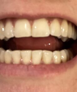 Remineralization Gel - 5 Syringes of Gel. Remineralizing and Reduces Teeth Sensitivity After Teeth Whitening Treatment 18 71E 6CrLMPL