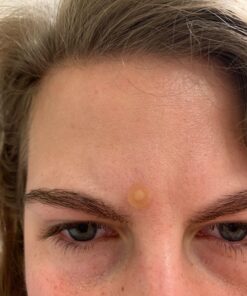 Nexcare Acne Cover, Skin Cover Absorbs Pus and Oil From Clogged Pores, Suitable Skincare for Most Skin Types - 36 Acne Covers 36 Count (Pack of 1) 40 71E2OcVaoIL