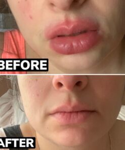 Dr. Dan's Cortibalm - 1 Pack - for Dry Cracked Lips - Healing Lip Balm for Severely Chapped Lips - Designed for Men, Women and Children 0.14 Ounce (Pack of 1) 34 71ERHjfggL