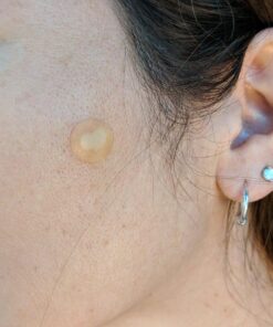 Nexcare Acne Cover, Skin Cover Absorbs Pus and Oil From Clogged Pores, Suitable Skincare for Most Skin Types - 36 Acne Covers 36 Count (Pack of 1) 38 71EeE5SRxtL