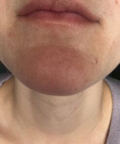 Dr. Dan's Cortibalm - 1 Pack - for Dry Cracked Lips - Healing Lip Balm for Severely Chapped Lips - Designed for Men, Women and Children 0.14 Ounce (Pack of 1) 26 71Fgc1fUsL