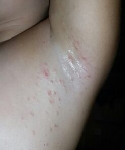 emuaid EMUAIDMAX Ointment 2oz - Eczema Cream. Maximum Strength Treatment. Use Max Strength for Athletes Foot, Psoriasis, Jock Itch, Anti Itch, Rash and Skin Yeast Infection. Standard Packaging 41 71GQC6tphL