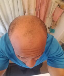 Pronexa Topical Hair Loss Serum by Hairgenics Stops Hair Loss and Accelerates Hair Growth and Hair Regrowth in Balding and Thinning Areas. 1 FL OZ. 26 71GewhF4A5L