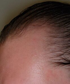 DHT BLOCKER - Hair Growth Supplement for Genetic Thinning for Men and Women | Approved* by American Hair Loss Association | Guaranteed, Backed by 20 Years of Experience in Hair Loss Treatment Clinics 51 71ISwEU0IqL