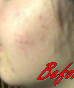 Acne Vitamins & Acne Supplements for Acne Treatment - Acne Pills & Acne Vitamin Supplements for Cystic Acne Treatment - Face, Back, Body & Hormonal Acne Treatment for Teens, Women & Men - 90 Pills 1 25 71J0t07Sl4L