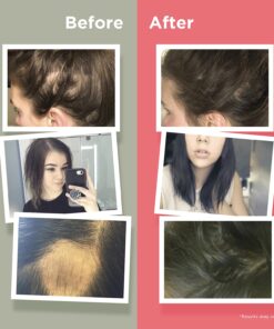 Naturenetics HairAnew Hair Growth Vitamins for Women & Men - Hair Vitamins For Faster Hair Growth & Thickness - Part of Proceeds go to Hair Loss Charity - Vegan Hair Supplement For Hair Skin Nails (1) 1 24 71JXJLm7McL