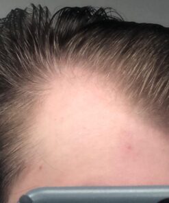 DHT BLOCKER - Hair Growth Supplement for Genetic Thinning for Men and Women | Approved* by American Hair Loss Association | Guaranteed, Backed by 20 Years of Experience in Hair Loss Treatment Clinics 64 71Jk5wXqRuL