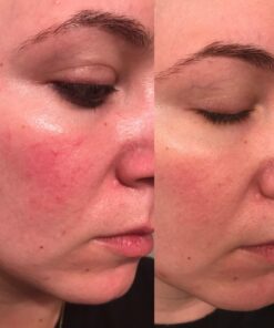 PUR360 Tamanu Oil - Best Treatment for Psoriasis, Eczema, Acne Scar, Rosacea - Relief for Dry, Scaly Skin, Scalp and More - Cold Pressed – Proven 100% Pure 35 71Jy0O48PwL