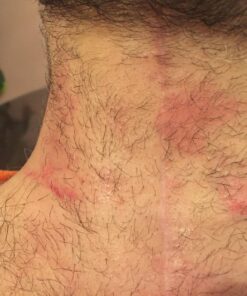 NewGel+E Advanced Silicone Scar Treatment Gel for OLD and NEW Scars w Vitamin E, for Surgery, Injury, Keloids, Burns, and Facial Blemish Scars (1 oz) 1 Ounce 24 71KTkdPKdCL