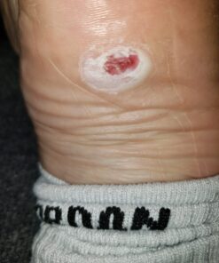 Compound W Wart Remover Maximum Strength One Step Pads, 14 Medicated Pads 14 Count (Pack of 1) 46 71LChIpvhUL