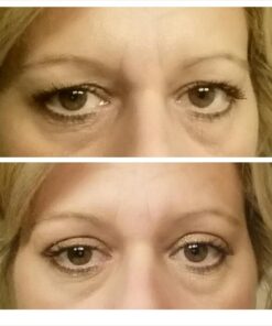 Eye Magic Original Eye Lift Kit (Small/Medium Size With Gel) Lifts Eyelid Droop and Hooded Eyes | Open And Show Off Your Beautiful Eyes | Made In America 17 71MORxNuw3L