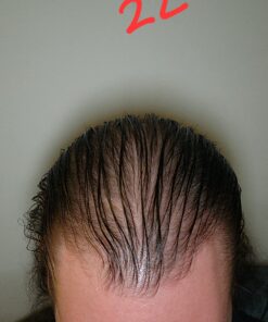 DHT BLOCKER - Hair Growth Supplement for Genetic Thinning for Men and Women | Approved* by American Hair Loss Association | Guaranteed, Backed by 20 Years of Experience in Hair Loss Treatment Clinics 52 71Nx9mB9j7L