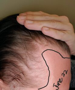 DHT BLOCKER - Hair Growth Supplement for Genetic Thinning for Men and Women | Approved* by American Hair Loss Association | Guaranteed, Backed by 20 Years of Experience in Hair Loss Treatment Clinics 53 71O EIIwJbL