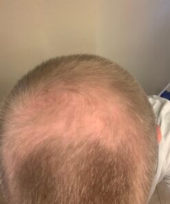 iRestore Essential Laser Hair Growth System - FDA Cleared Hair Loss Treatments for Men & Women & Hair Growth Products for Men with Thinning Hair, Hair Regrowth Treatments Laser Cap, Red Light Therapy 37 71OrCl2sYL