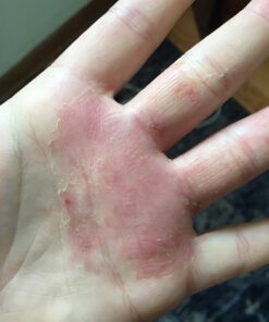 PUR360 Tamanu Oil - Best Treatment for Psoriasis, Eczema, Acne Scar, Rosacea - Relief for Dry, Scaly Skin, Scalp and More - Cold Pressed – Proven 100% Pure 44 71Otnh7CIBL