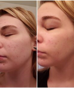 Tea Tree Essential Oil, 1 Fl Oz with Dropper - Undiluted Therapeutic Grade for Your Face, Skin, Hair and Diffuser - 100% Pure Melaleuca Oil for Acne, Toenails - by Pure Body Naturals 1 Fl Oz (Pack of 1) 44 71OyH10RMcL