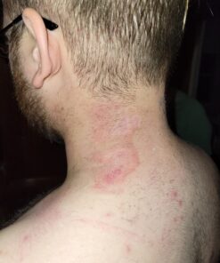 SilverSeal Burn and Wound Dressing | Hydrogel Pads with X-Static Silver | Soothing, Moist & Protective | Burns, Cuts & Wounds | 4 Sterile Dressings 4"x4" Patch (4 Count) 57 71OybnLdK5L