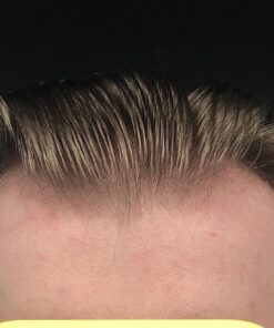 DHT BLOCKER - Hair Growth Supplement for Genetic Thinning for Men and Women | Approved* by American Hair Loss Association | Guaranteed, Backed by 20 Years of Experience in Hair Loss Treatment Clinics 65 71QAyFB8JsL