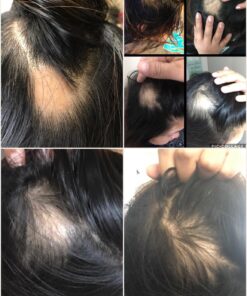 Naturenetics HairAnew Hair Growth Vitamins for Women & Men - Hair Vitamins For Faster Hair Growth & Thickness - Part of Proceeds go to Hair Loss Charity - Vegan Hair Supplement For Hair Skin Nails (1) 1 37 71QUjtoa8RL