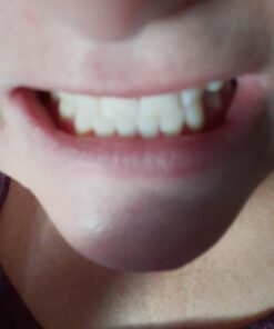 Remineralization Gel - 5 Syringes of Gel. Remineralizing and Reduces Teeth Sensitivity After Teeth Whitening Treatment 22 71Qfyr5HnGL