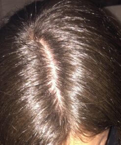 Head and Shoulders Clinical Strength Dandruff and Seborrheic Dermatitis Shamp 13.5 Fl Oz(Pack of 2) 24 71T0KkIGzWL