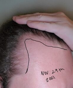 DHT BLOCKER - Hair Growth Supplement for Genetic Thinning for Men and Women | Approved* by American Hair Loss Association | Guaranteed, Backed by 20 Years of Experience in Hair Loss Treatment Clinics 55 71UhMCh74oL