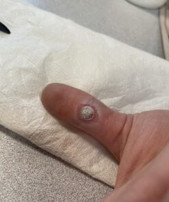 Compound W Wart Remover Maximum Strength One Step Pads, 14 Medicated Pads 14 Count (Pack of 1) 52 71UsjrJp5OL