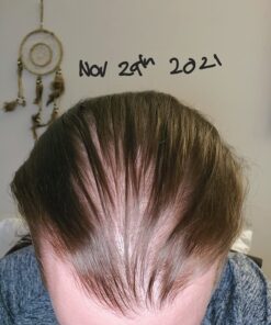 DHT BLOCKER - Hair Growth Supplement for Genetic Thinning for Men and Women | Approved* by American Hair Loss Association | Guaranteed, Backed by 20 Years of Experience in Hair Loss Treatment Clinics 56 71X5uKOxlxL