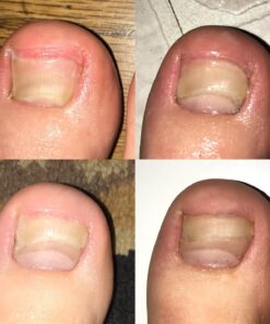 PURELY NORTHWEST-Tea Tree Oil & Peppermint Foot Soak with Epsom Salt-for Stubborn Foot Odor, Athletes Foot Burning & Itching, Damaged Discolored Nails-A Natural Callus Remover 16 Ounces 1 Pound (Pack of 1) 36 71X6pxCmKzL