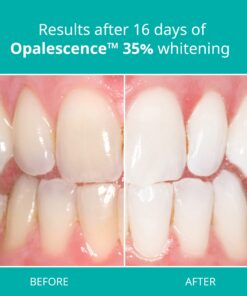 Opalescence 35% Gel Syringes Teeth Whitening - Refill Kit (2 Packs / 4 Count) Carbamide Peroxide. Made by Ultradent, in Cool Mint Flavor. Tooth Whitening Refill Syringes 5197-2 Mint 35 4 Count (Pack of 1) 26 71XvQjBjA2L