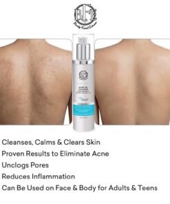 Beauty Facial Extreme Acne Gel Cleanser - 10% Benzoyl Peroxide, Fight Acne Blemishes on Contact for Cystic Breakouts, Oily Skin, Clogged Pores, Blackhead, Whitehead & Pimples. Achieve Clear Skin. 13 71b deBOFAL