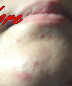 Acne Vitamins & Acne Supplements for Acne Treatment - Acne Pills & Acne Vitamin Supplements for Cystic Acne Treatment - Face, Back, Body & Hormonal Acne Treatment for Teens, Women & Men - 90 Pills 1 26 71bY0nZsbKL