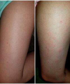 Eczema Cream for Adults & Kids - Eczema Psoriasis & Rosacea Care Cream for Dry Itchy Skin Relief - Face Body & Hand Eczema Moisturizer - Eczema Relief & Seborrheic Dermatitis Cream for Face 4 Ounce (Pack of 1) 39 71ccWKWCGRL 1