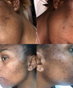 Glycolic Acid 30% Gel Peel with Chamomile and Green Tea Extracts - Professional Grade Chemical Face Peel for Acne Scars, Collagen Boost, Wrinkles, Fine Lines - Alpha Hydroxy Acid - 1 Bottle of 1 fl oz 1 Fl Oz (Pack of 1) 30 71cts9EfnHL