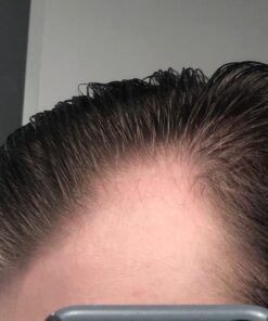 DHT BLOCKER - Hair Growth Supplement for Genetic Thinning for Men and Women | Approved* by American Hair Loss Association | Guaranteed, Backed by 20 Years of Experience in Hair Loss Treatment Clinics 66 71dzw3fb8ZL