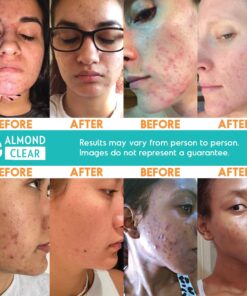 Face & Body Clearing Serum, Level 1- for acne, folliculitis, aging skin, ingrown hairs, dark spots - face, chest, butt, back, thighs, arms - mandelic acid - 1 fl oz 1 Fl Oz (Pack of 1) 18 71e1WKsyvJL 1