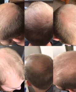 Men's Rogaine 5% Minoxidil Foam for Hair Loss and Hair Regrowth, Topical Treatment for Thinning Hair, 3-Month Supply, 2.11 Ounce (Pack of 3) Men's Rogaine Foam Treatment (3-Month Supply) 2.11 Ounce (Pack of 3) 55 71fgSUCY mL