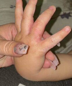 SilverSeal Burn and Wound Dressing | Hydrogel Pads with X-Static Silver | Soothing, Moist & Protective | Burns, Cuts & Wounds | 4 Sterile Dressings 4"x4" Patch (4 Count) 55 71fjZOoQ9jL