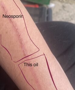 PUR360 Tamanu Oil - Best Treatment for Psoriasis, Eczema, Acne Scar, Rosacea - Relief for Dry, Scaly Skin, Scalp and More - Cold Pressed – Proven 100% Pure 32 71gKMXIPIaL