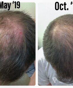 Growth Treatment Unscented 5% (Foam) 2 Ounce (Pack of 1) 23 71geeKE00fL