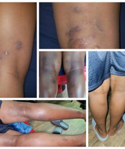 Eczema Cream for Adults & Kids - Eczema Psoriasis & Rosacea Care Cream for Dry Itchy Skin Relief - Face Body & Hand Eczema Moisturizer - Eczema Relief & Seborrheic Dermatitis Cream for Face 4 Ounce (Pack of 1) 27 71gnUtz5 jL 1