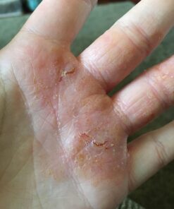 PUR360 Tamanu Oil - Best Treatment for Psoriasis, Eczema, Acne Scar, Rosacea - Relief for Dry, Scaly Skin, Scalp and More - Cold Pressed – Proven 100% Pure 45 71gv5GwKFQL