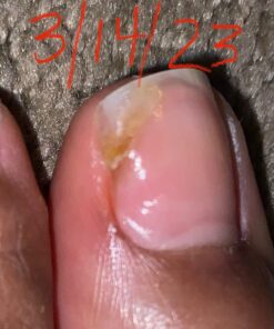 Toenail Renewal Solution Extra Strength Care for Toe Nail & Fingernails - Nail Repair Solution for Thick, broken, Discolored Nails - Renews Damaged Cracked Ingrown Toenail - Tea Tree Oil for Healthier and Extra Strength Nails - Made In USA 0.50 Fl Oz 60 71hM8r ahRL