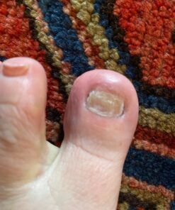 emuaid EMUAIDMAX Ointment 2oz - Eczema Cream. Maximum Strength Treatment. Use Max Strength for Athletes Foot, Psoriasis, Jock Itch, Anti Itch, Rash and Skin Yeast Infection. Standard Packaging 47 71hYaldV9vL