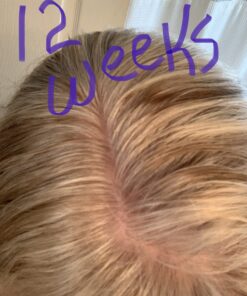 DHT BLOCKER - Hair Growth Supplement for Genetic Thinning for Men and Women | Approved* by American Hair Loss Association | Guaranteed, Backed by 20 Years of Experience in Hair Loss Treatment Clinics 48 71iPlHsf7L