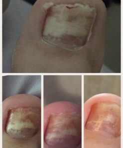 PUR360 Manuka Oil, 33x More Powerful Than Tea Tree Oil - Best Treatment for Toenails, Acne, Irritated Skin, Feet and more 0.33 Fl Oz (Pack of 1) 43 71jQe3s5bWL